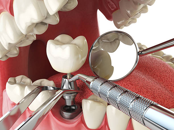 Best Emergency Treatment for Dental Infections or Abscesses in Buffalo, TX